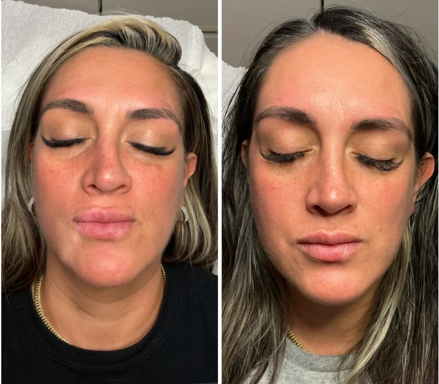 Clinic-supplied before-and-after skin comparison 1, shown side by side