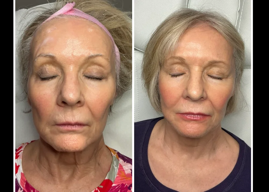 Clinic-supplied before-and-after skin comparison 2, shown side by side