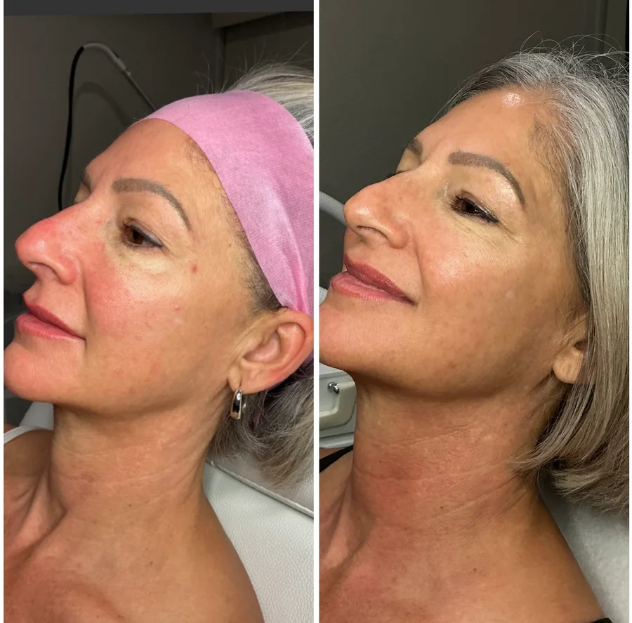 Clinic-supplied before-and-after skin comparison 3, shown side by side